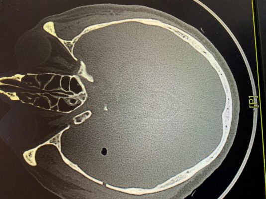 Innovativo intervento neurochirurgico all’A.O.R.N. “San Pio”