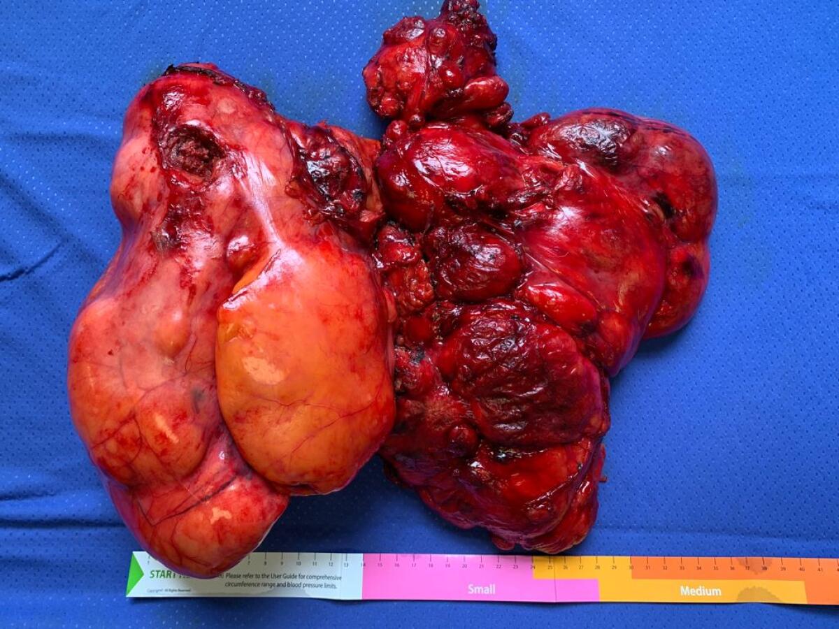 A.O.Moscati: asportazione di un liposarcoma del peso di 4 chili. - 
