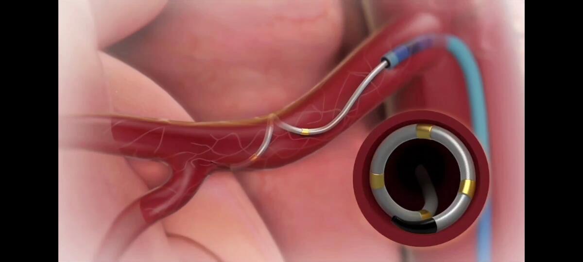 Il Covid-19 non ferma i progressi in Cardiologia al Fatebenefratelli - 