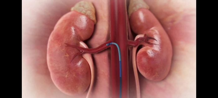 Il Covid-19 non ferma i progressi in Cardiologia al Fatebenefratelli