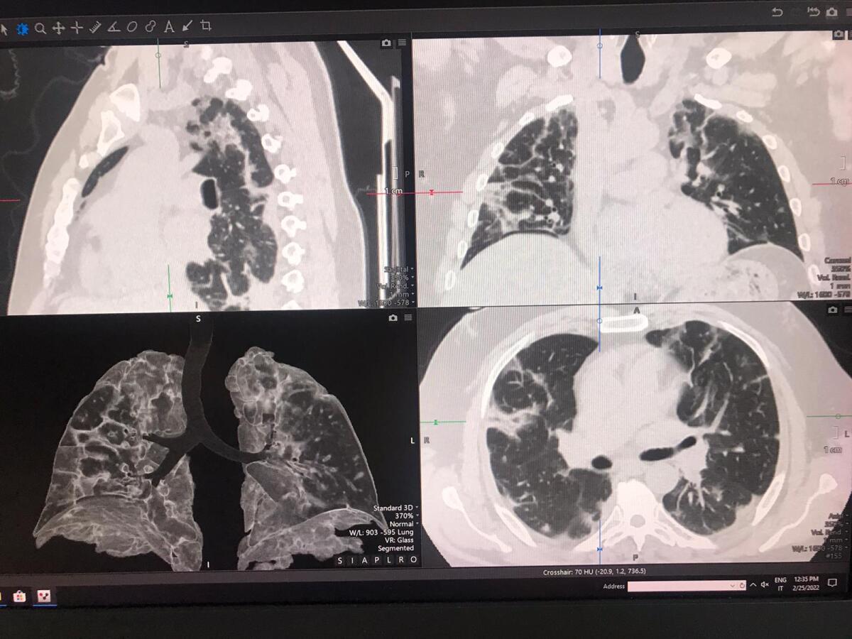  TAC di ultima generazione in grado di predire l’evoluzione verso la fibrosi polmonare. - 
