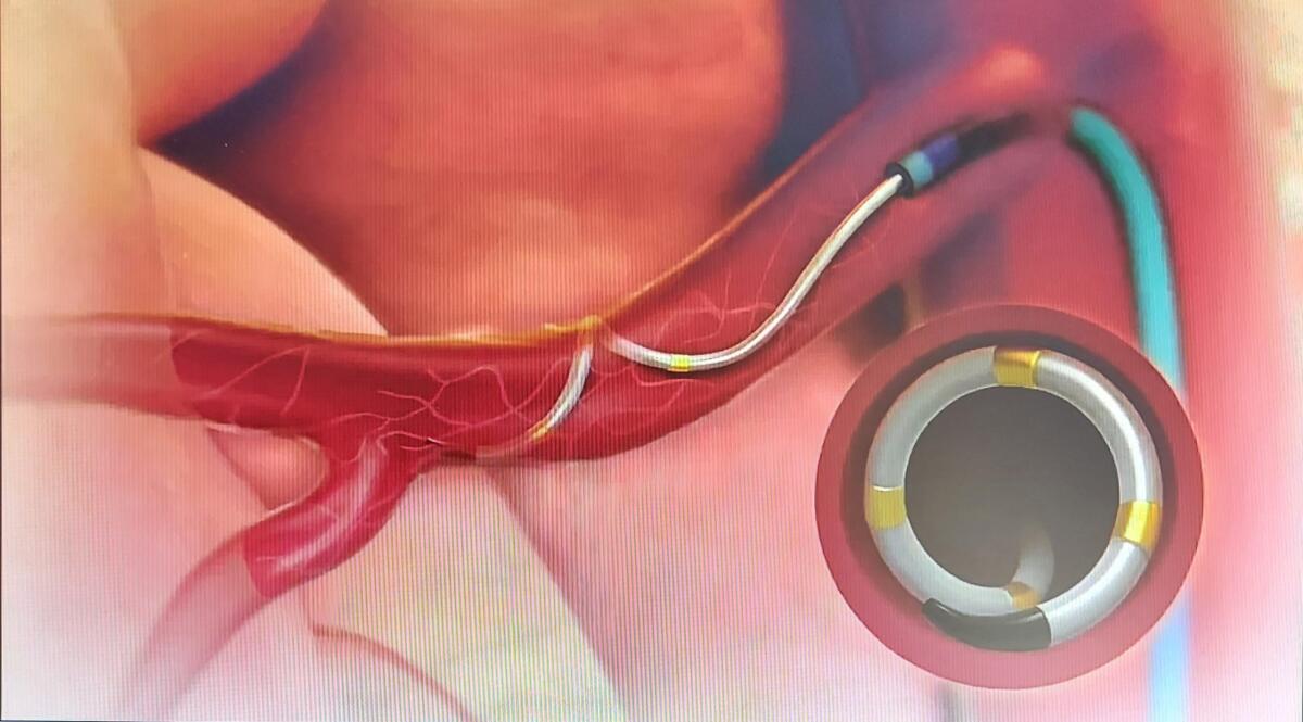 Fatebenefratelli:"Denervazione Percutanea delle Arterie Renali" - 