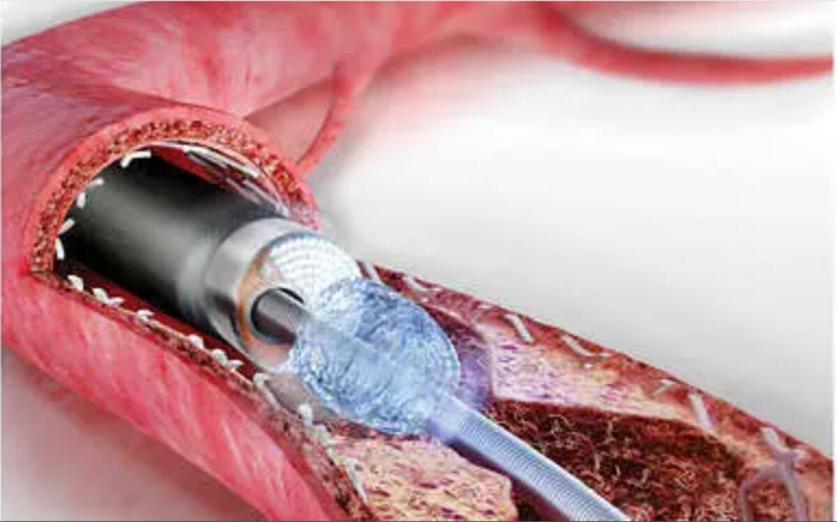 Laser intra-coronarico per PTCA complesse: primo caso al Fatebenefratelli - 