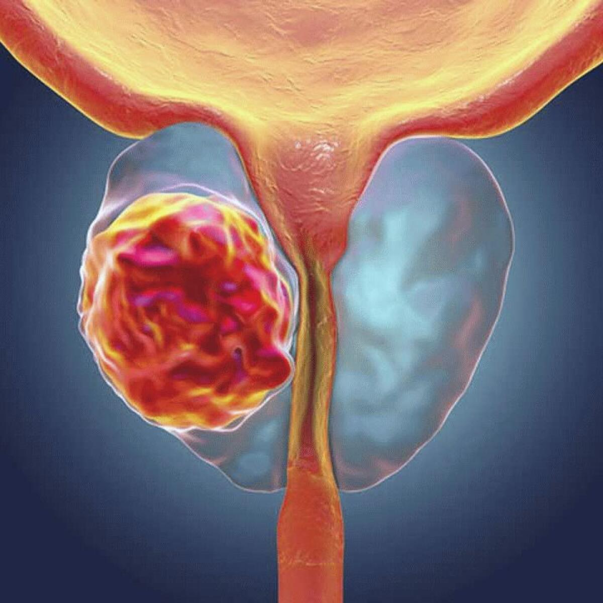 Qualità della vita dopo il tumore alla prostata. - 