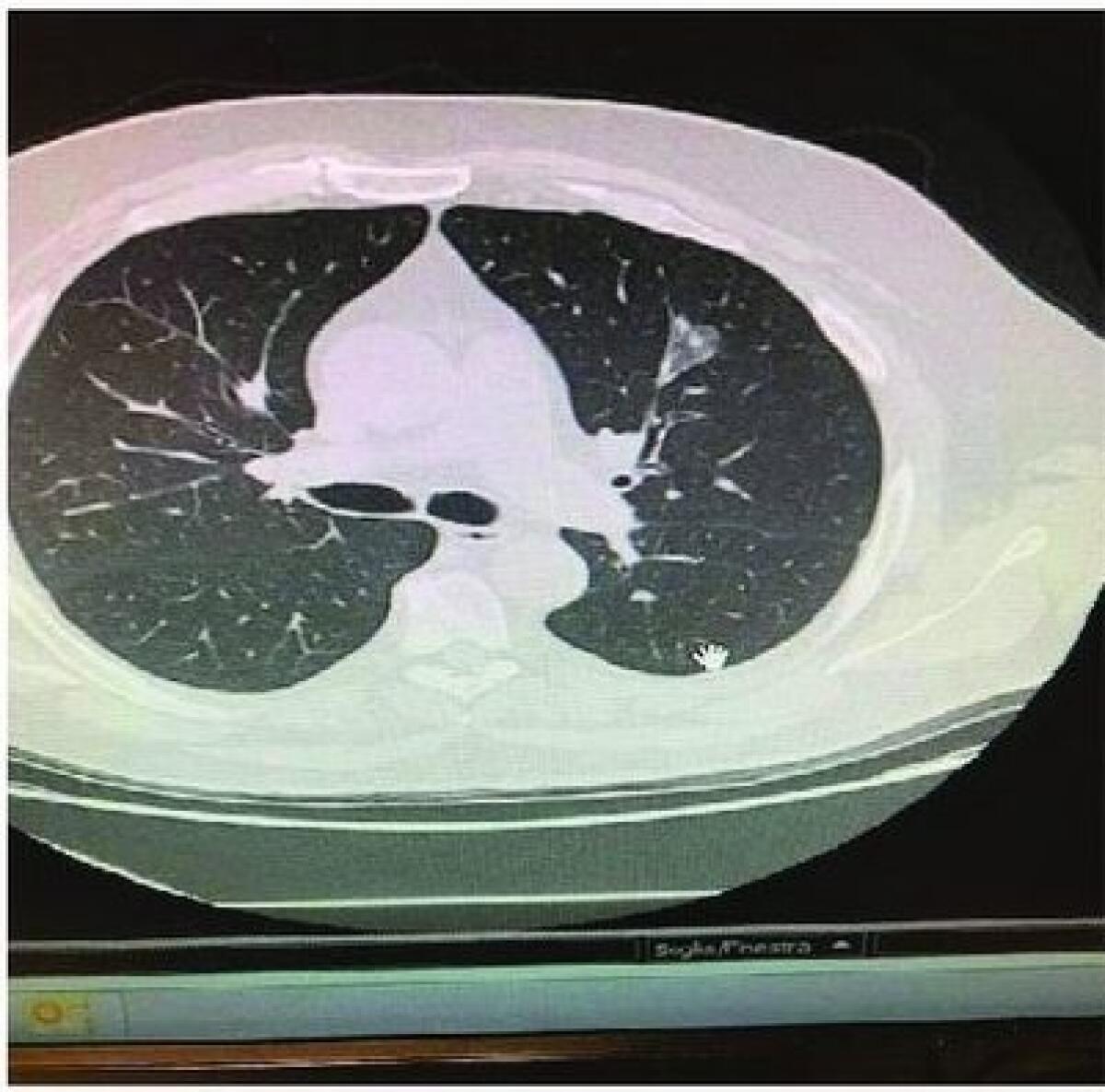 Un nuovo modello di screening per il cancro del polmone potrebbe aumentare la sopravvivenza. - 
