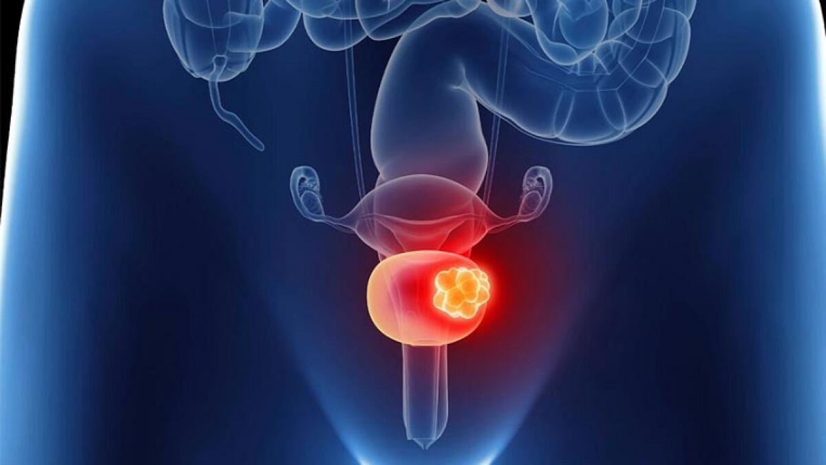 Tumori, cancro uroteliale: nuova terapia dimezza mortalità e raddoppia sopravvivenza - 