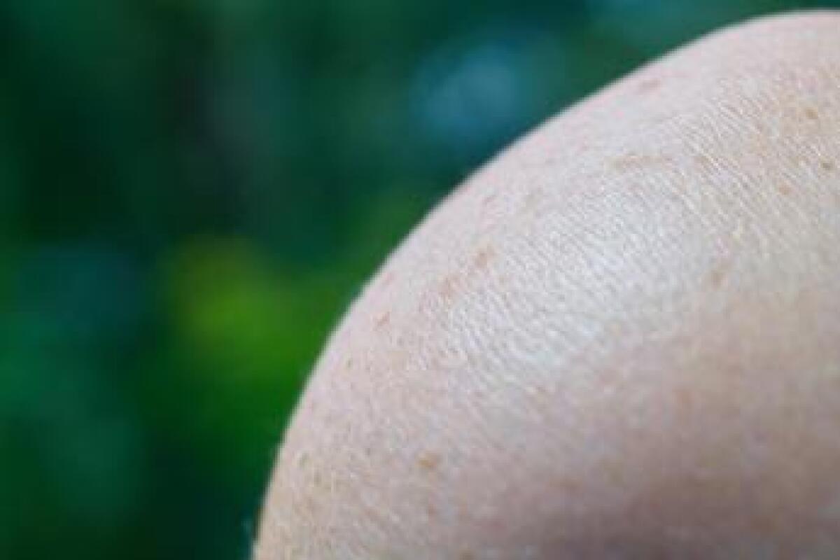 Cos'è il melanoma? Sintomi, prevenzione e successi dell'immunoterapia - 