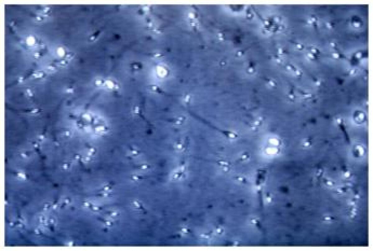 Infertilità maschile, dietro c'è gene mancante: spermatozoi sono 'sconnessi' - 