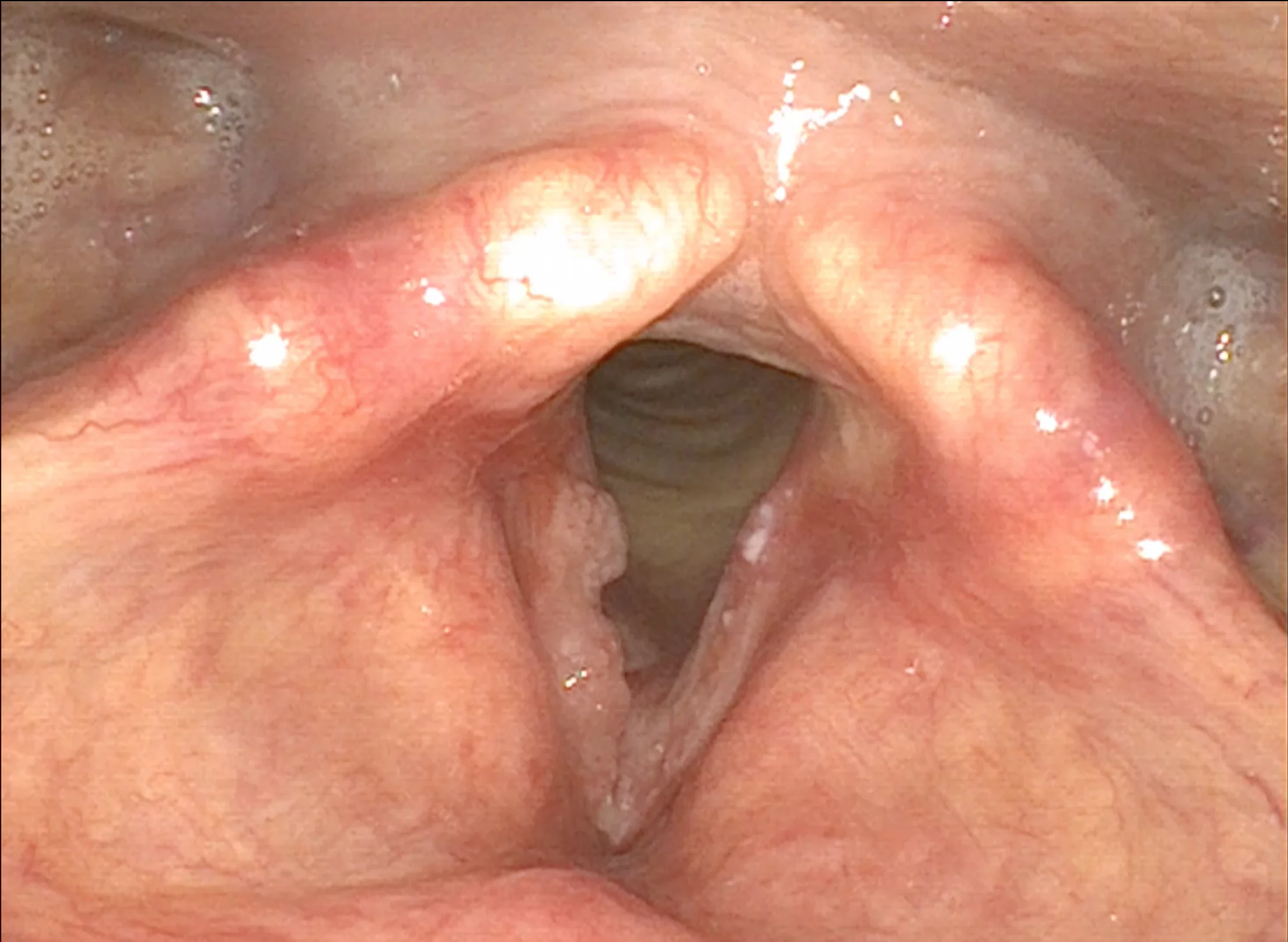 Da studio Biogem nuove armi contro il carcinoma squamoso dellalaringe