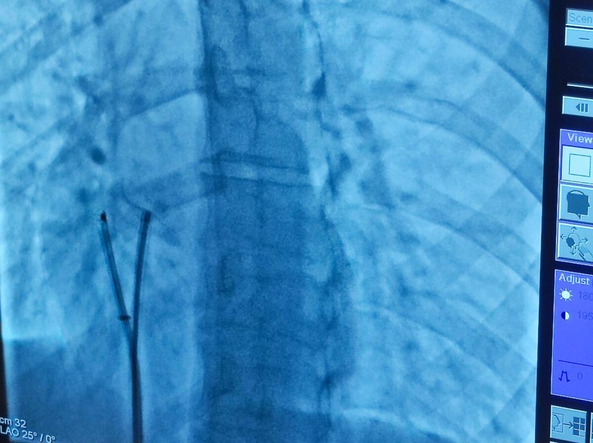 Focus On sul trattamento delle Cardiopatie Congenite - 