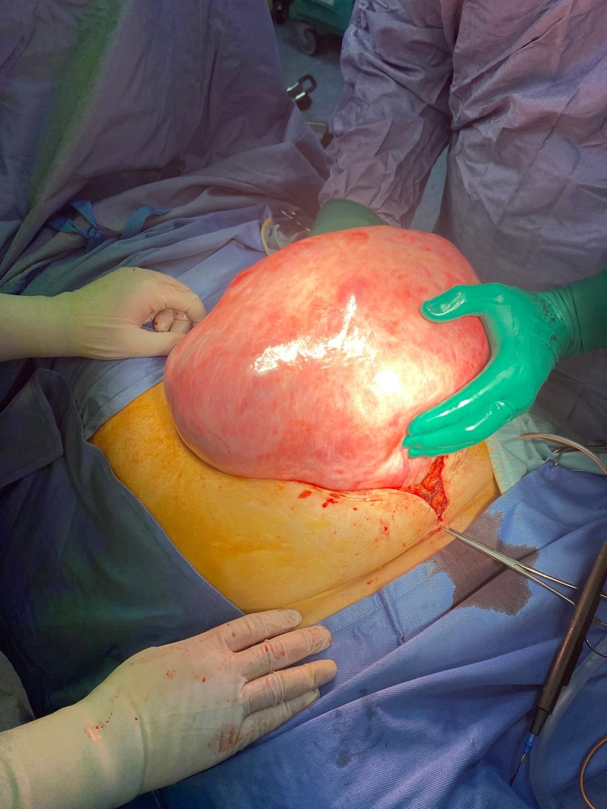 Importante intervento di Isterectomia radicale all'Ospedale di Ariano Irpino. - 