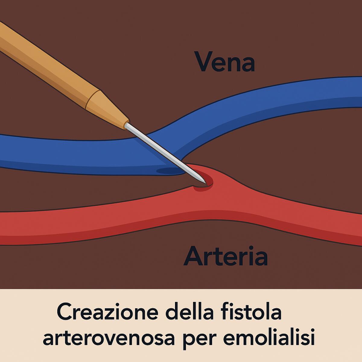 Dialisi più semplice e meno dolorosa: all’Azienda Moscati con tecnica mini invasiva - 
