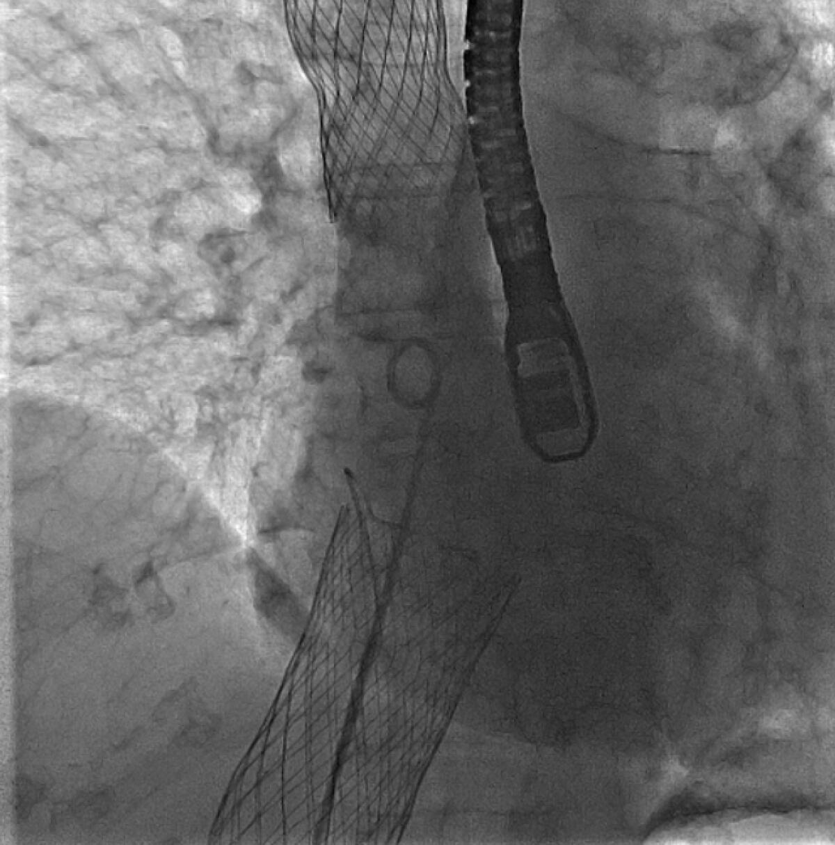 Al Fatebenefratelli "Impianto Percutaneo di Valvola Tricuspide" - 