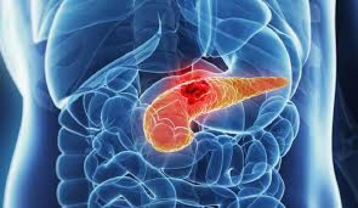 Tumore pancreas, mix con chemioterapici migliora la sopravvivenza - 