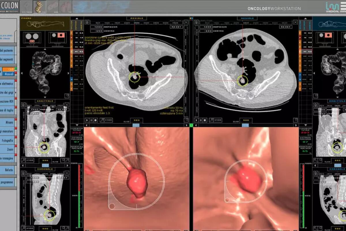 Tumore del retto, con il nuovo protocollo remissione senza chirugia - 